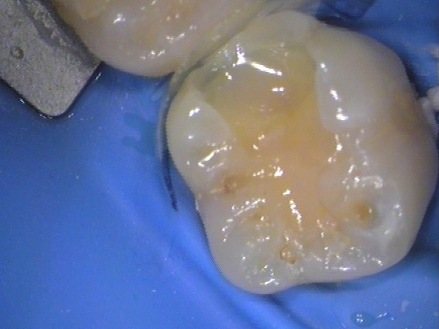 レジン　虫歯　セラミック治療　自由が丘　歯医者