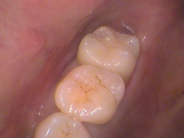 ドックスベストセメント　失敗　予後　虫歯　自由が丘　歯医者