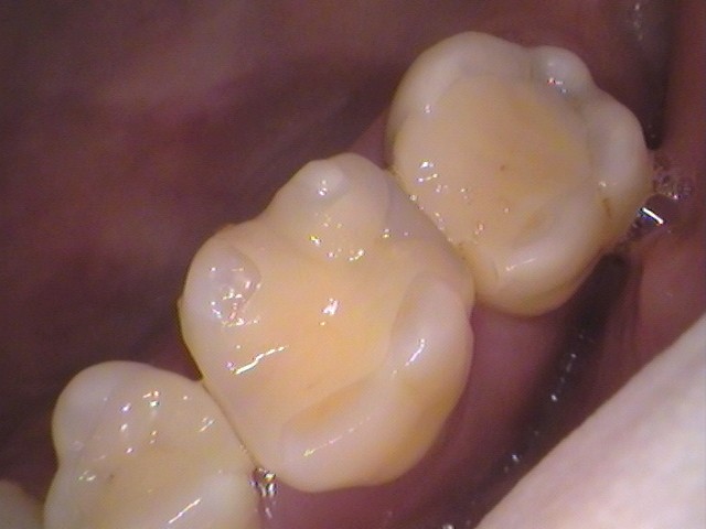 詰め物の下の虫歯　セラミック　自由が丘　歯医者