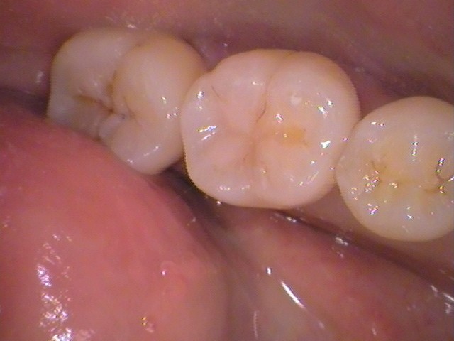 ダイレクトボンディング　レジン　虫歯　自由が丘　歯医者