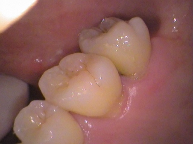 ドックスベストセメント　失敗　予後　虫歯　自由が丘　歯医者