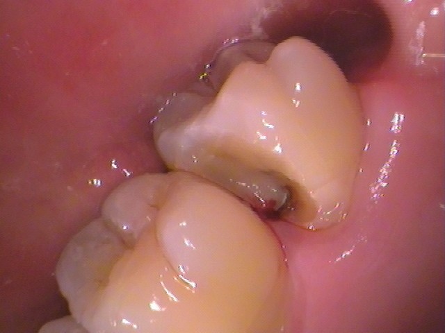 ドックスベストセメント　失敗　予後　虫歯　自由が丘　歯医者