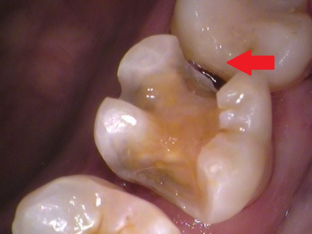 ゴールドインレー　金合金　白金加金　自由が丘　歯医者