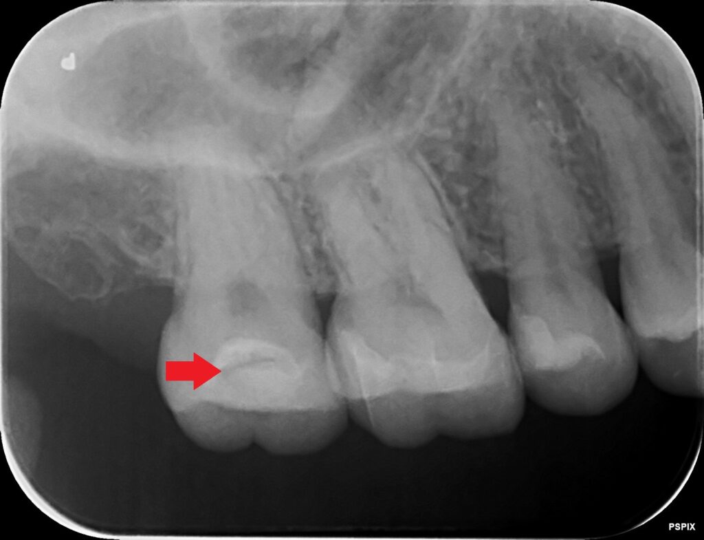 詰め物の下の虫歯　セラミック　自由が丘　歯医者