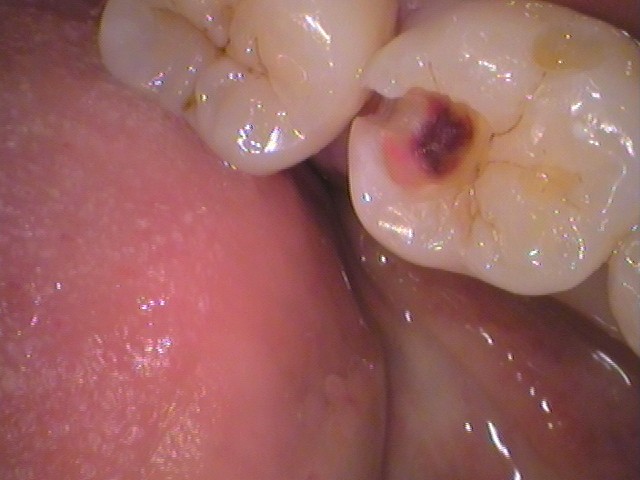 ダイレクトボンディング　レジン　虫歯　自由が丘　歯医者