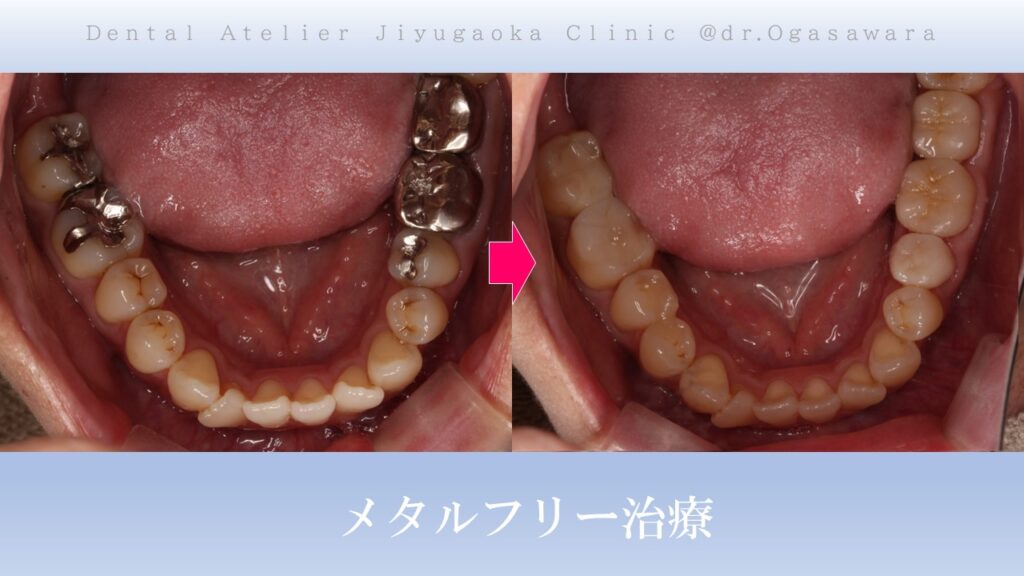 銀歯交換　セラミック　歯医者　自由が丘