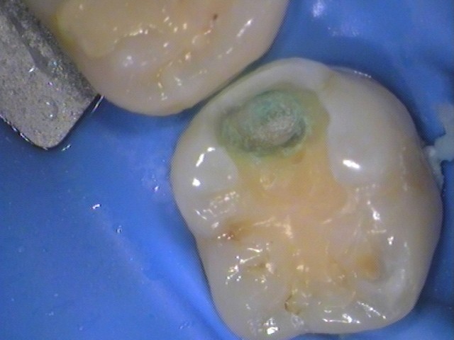 レジン　虫歯　セラミック治療　自由が丘　歯医者