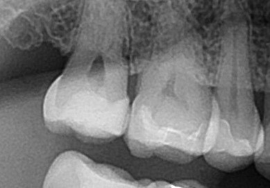 詰め物の下の虫歯　セラミック　自由が丘　歯医者