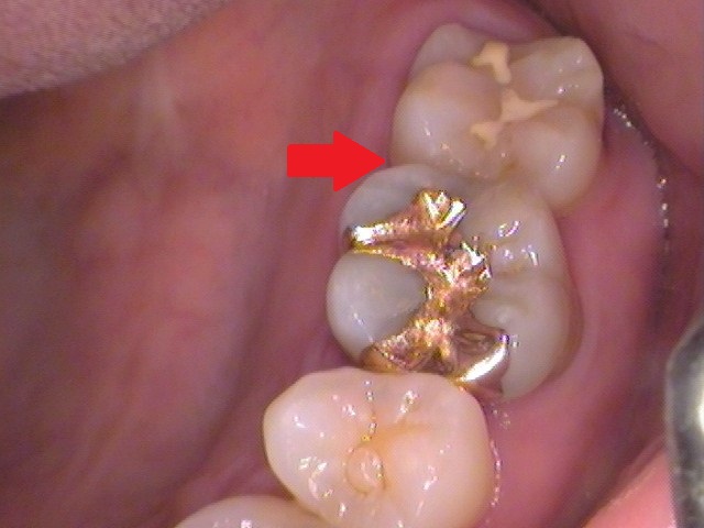 ゴールドインレー　金合金　白金加金　自由が丘　歯医者