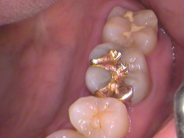 ゴールドインレー　金合金　白金加金　自由が丘　歯医者