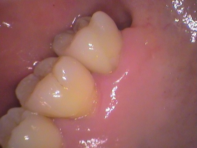 ドックスベストセメント　失敗　予後　虫歯　自由が丘　歯医者