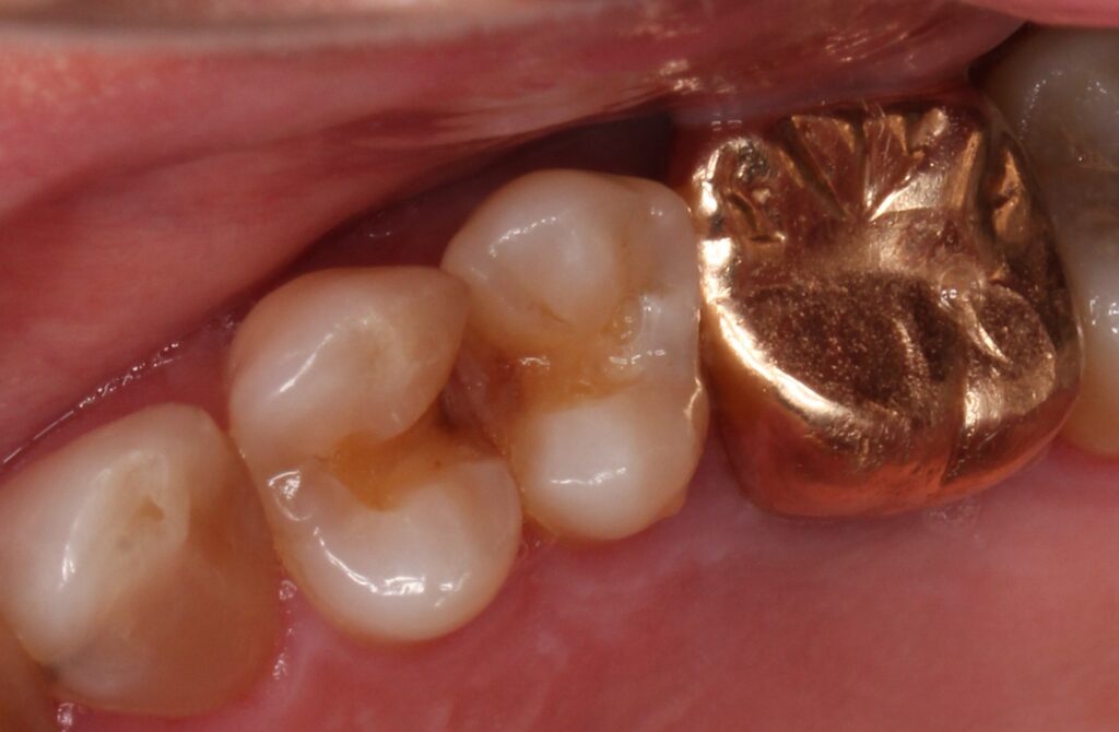銀歯外れた　虫歯　セラミック　自由が丘　歯医者