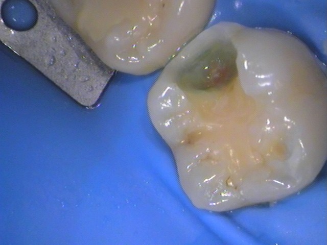 レジン　虫歯　セラミック治療　自由が丘　歯医者