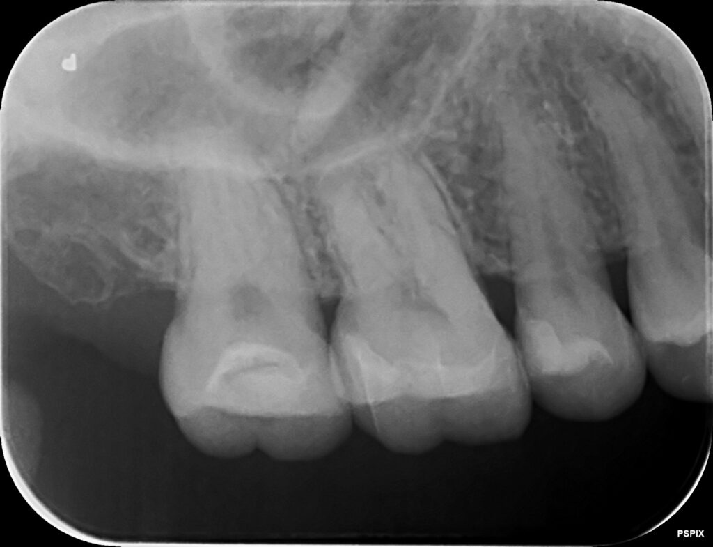 詰め物の下の虫歯　セラミック　自由が丘　歯医者