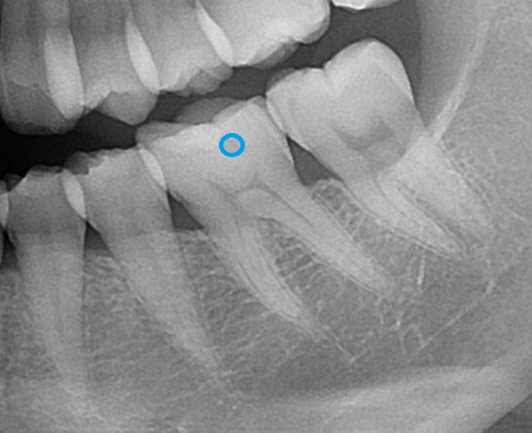 ダイレクトボンディング　レジン　虫歯　自由が丘　歯医者