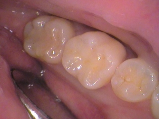 レジン　虫歯　セラミック治療　自由が丘　歯医者