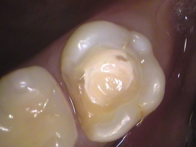詰め物の下の虫歯　セラミック　自由が丘　歯医者