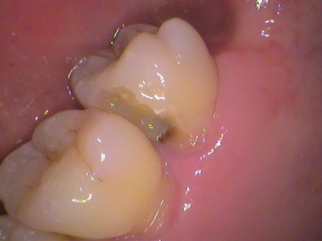 ドックスベストセメント　失敗　予後　虫歯　自由が丘　歯医者