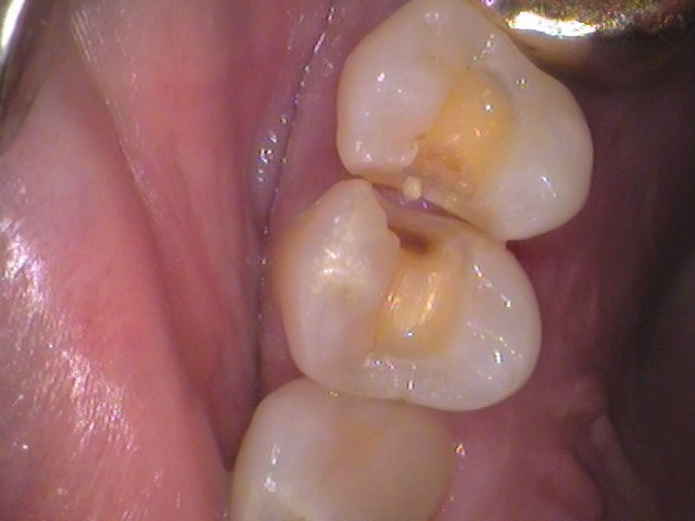 銀歯外れた　虫歯　セラミック　自由が丘　歯医者