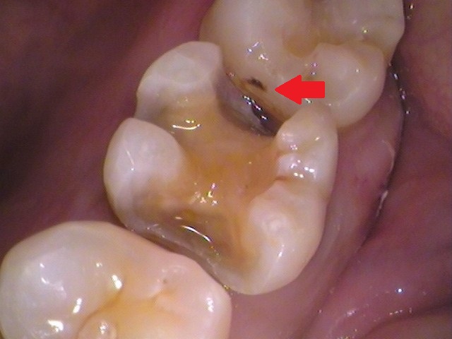ゴールドインレー　金合金　白金加金　自由が丘　歯医者