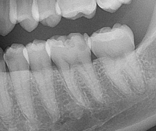 レジン　虫歯　セラミック治療　自由が丘　歯医者