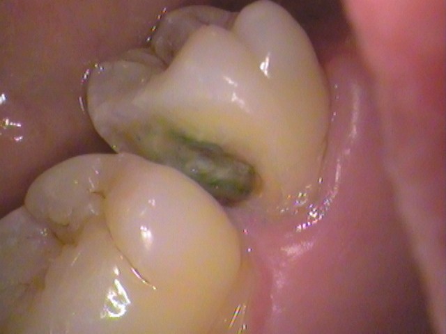 ドックスベストセメント　失敗　予後　虫歯　自由が丘　歯医者