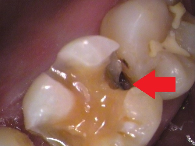 ゴールドインレー　金合金　白金加金　自由が丘　歯医者