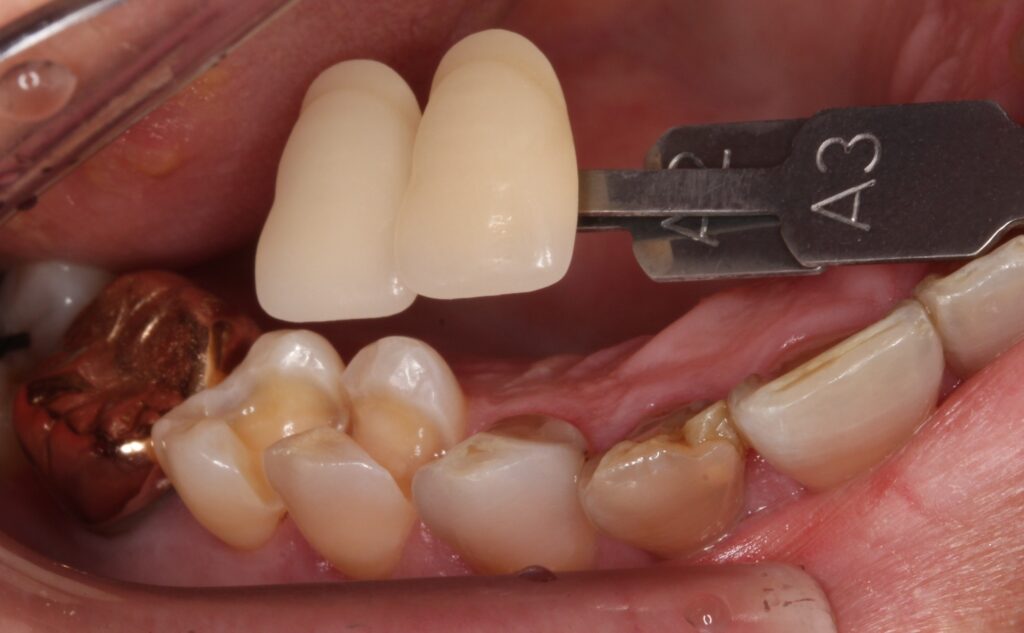 銀歯外れた　虫歯　セラミック　自由が丘　歯医者
