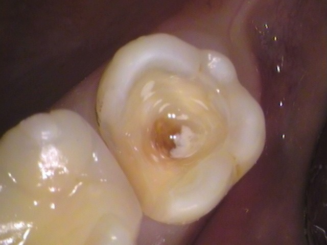 詰め物の下の虫歯　セラミック　自由が丘　歯医者
