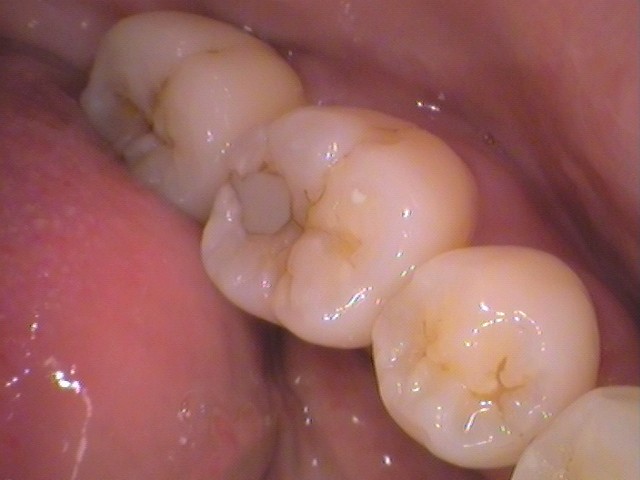 ダイレクトボンディング　レジン　虫歯　自由が丘　歯医者