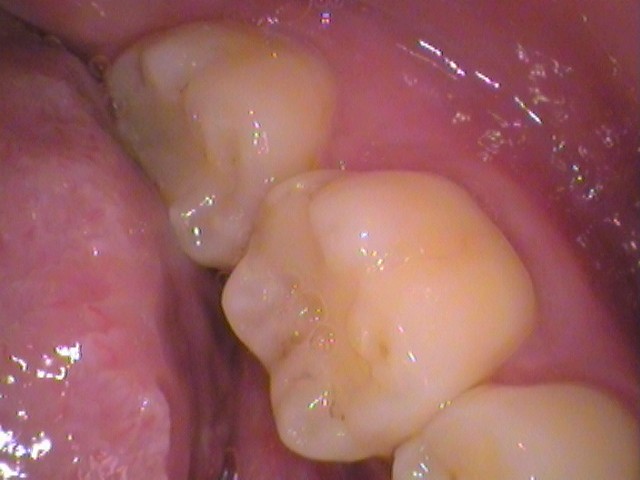 レジン　虫歯　セラミック治療　自由が丘　歯医者