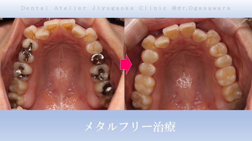 銀歯交換　セラミック　歯医者　自由が丘