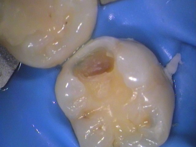 レジン　虫歯　セラミック治療　自由が丘　歯医者