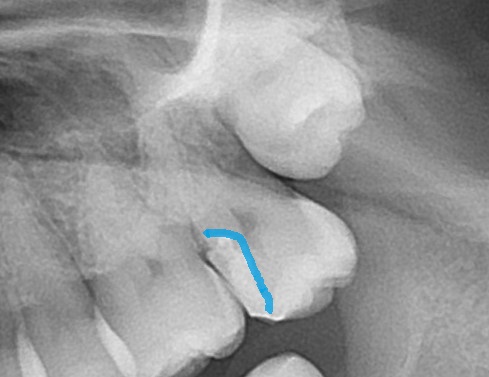 ドックスベストセメント　失敗　予後　虫歯　自由が丘　歯医者