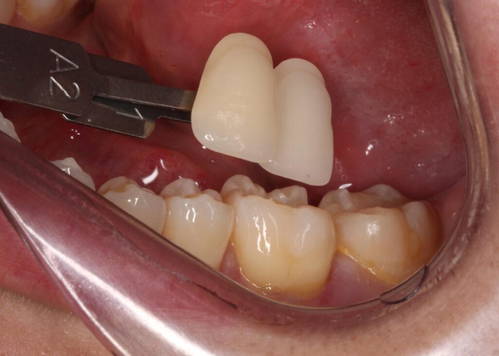 レジン　虫歯　セラミック治療　自由が丘　歯医者