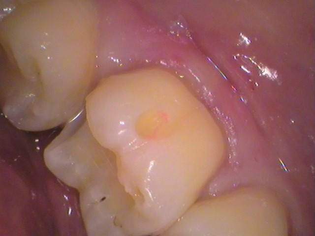 レジン　虫歯　セラミック治療　自由が丘　歯医者