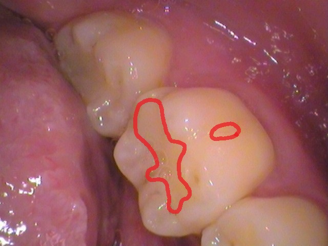 レジン　虫歯　セラミック治療　自由が丘　歯医者