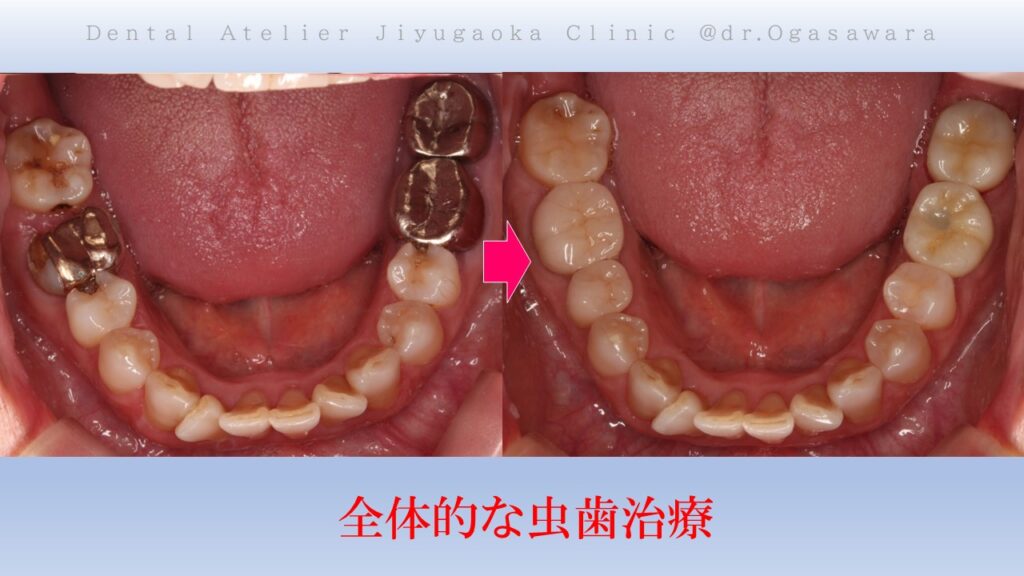 虫歯でボロボロ　虫歯治療　セラミック治療　インプラント治療　根管治療　自由が丘　歯医者