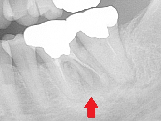 虫歯でボロボロ　虫歯治療　セラミック治療　インプラント治療　根管治療　自由が丘　歯医者