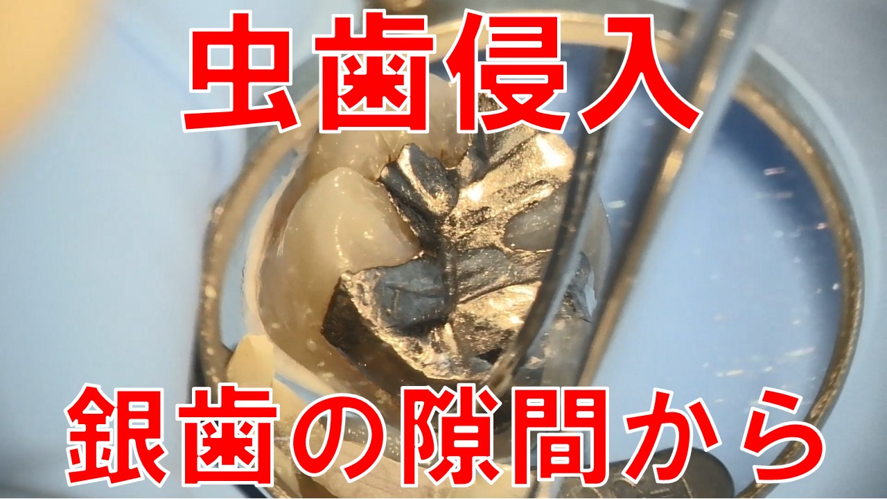 銀歯の下の虫歯　歯医者　自由が丘　虫歯動画