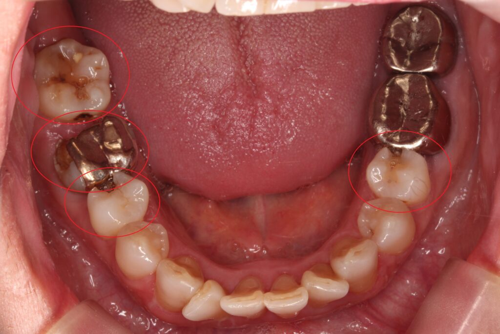 虫歯でボロボロ　虫歯治療　セラミック治療　インプラント治療　根管治療　自由が丘　歯医者