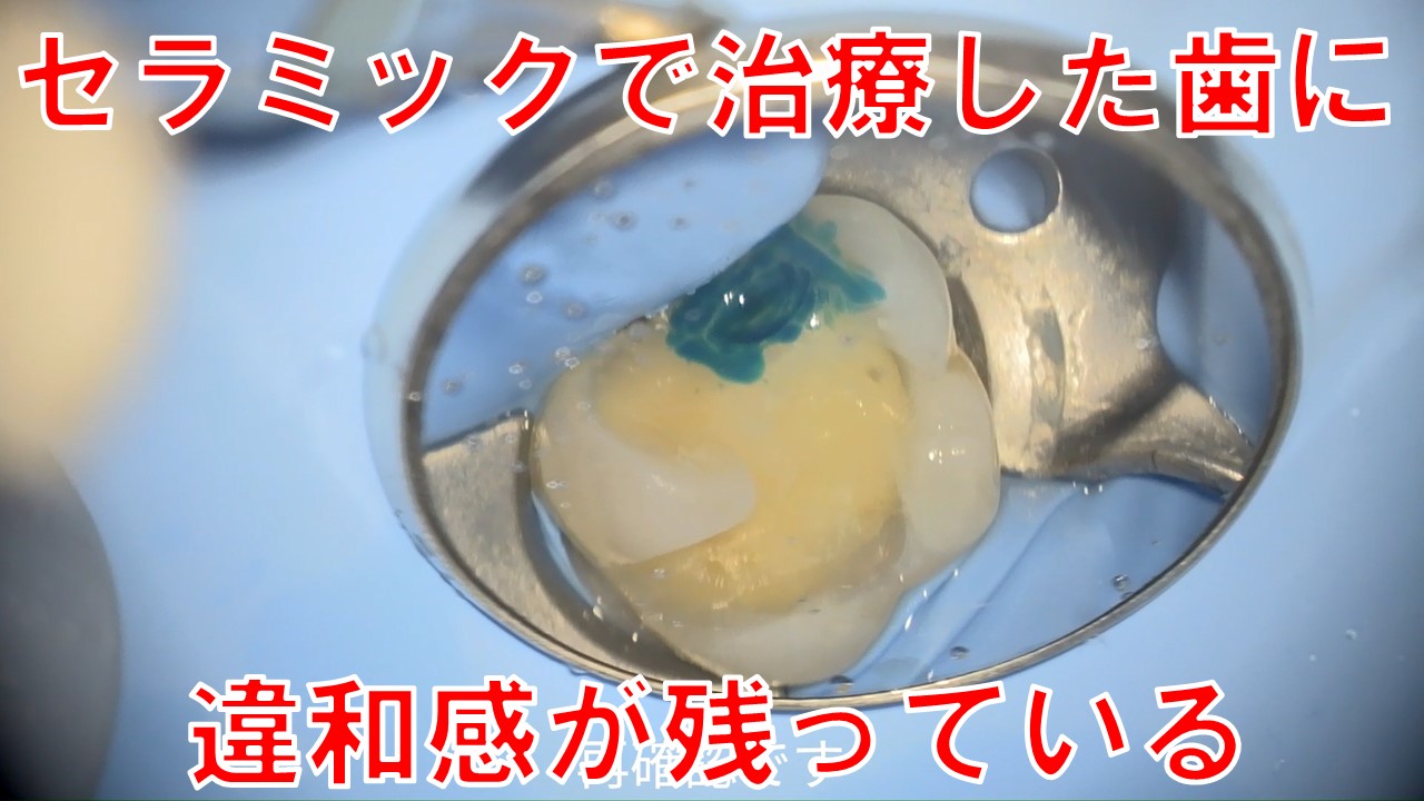 セラミック　歯　痛み　違和感　原因