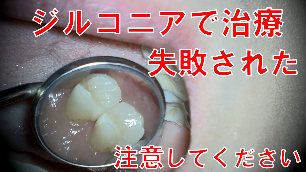 ジルコニア　インレー　クラウン　フロスが引っかかる　しみる　歯医者　自由が丘