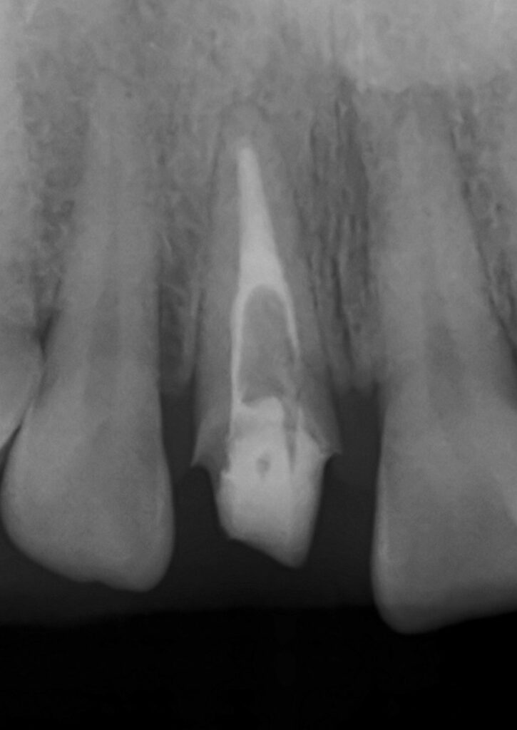 根管治療をやり直したエックス線写真