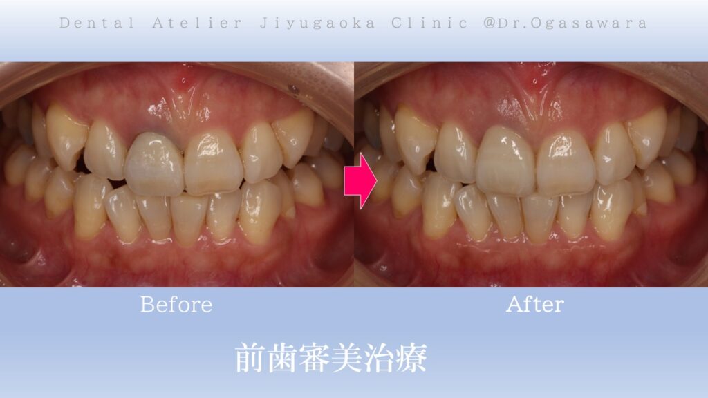 古い差し歯の変色ビフォーアフターオールセラミックスクラウン