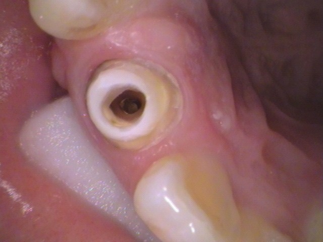 ファイバーコア