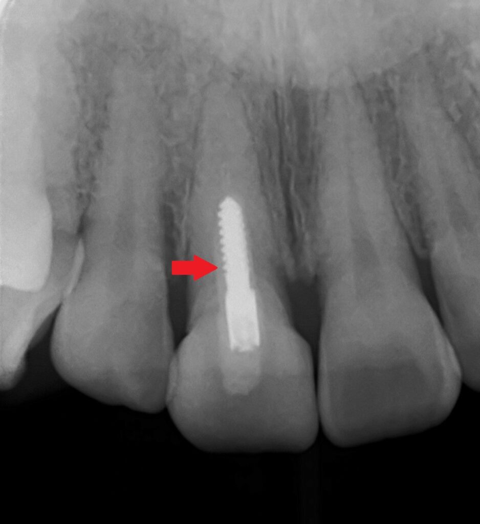 前歯スクリューピン