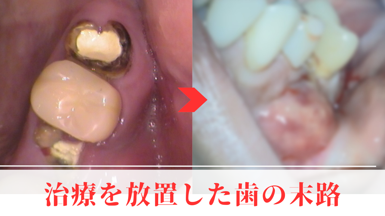 歯ぐきの腫れ　虫歯治療　放置　治療途中　痛い　顔が腫れた