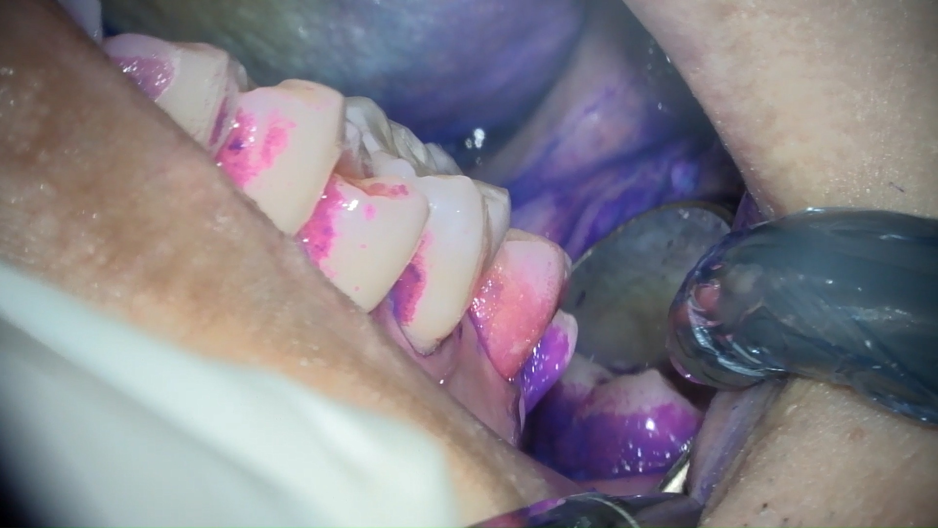 歯ぐきから出血　歯周病　歯肉炎　歯医者　自由が丘