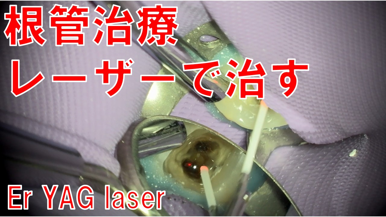 根管治療　レーザー治療　歯科　歯医者　自由が丘　マイクロエンド　
